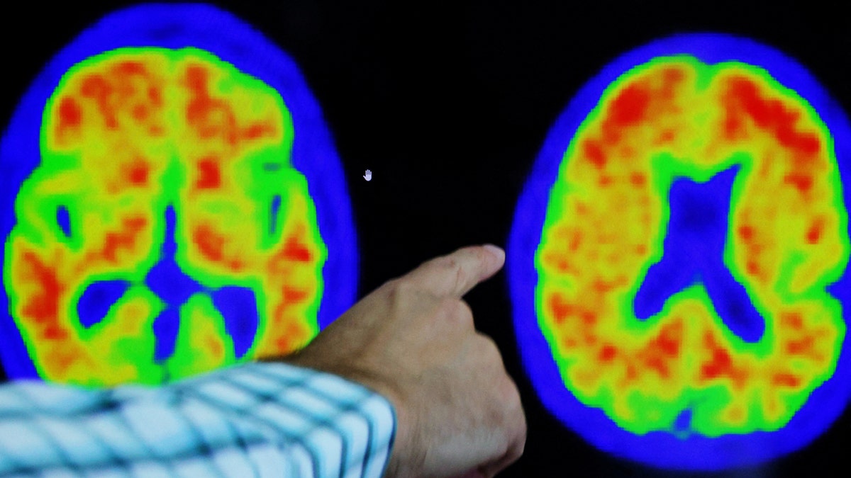 Alzheimer's PET scan