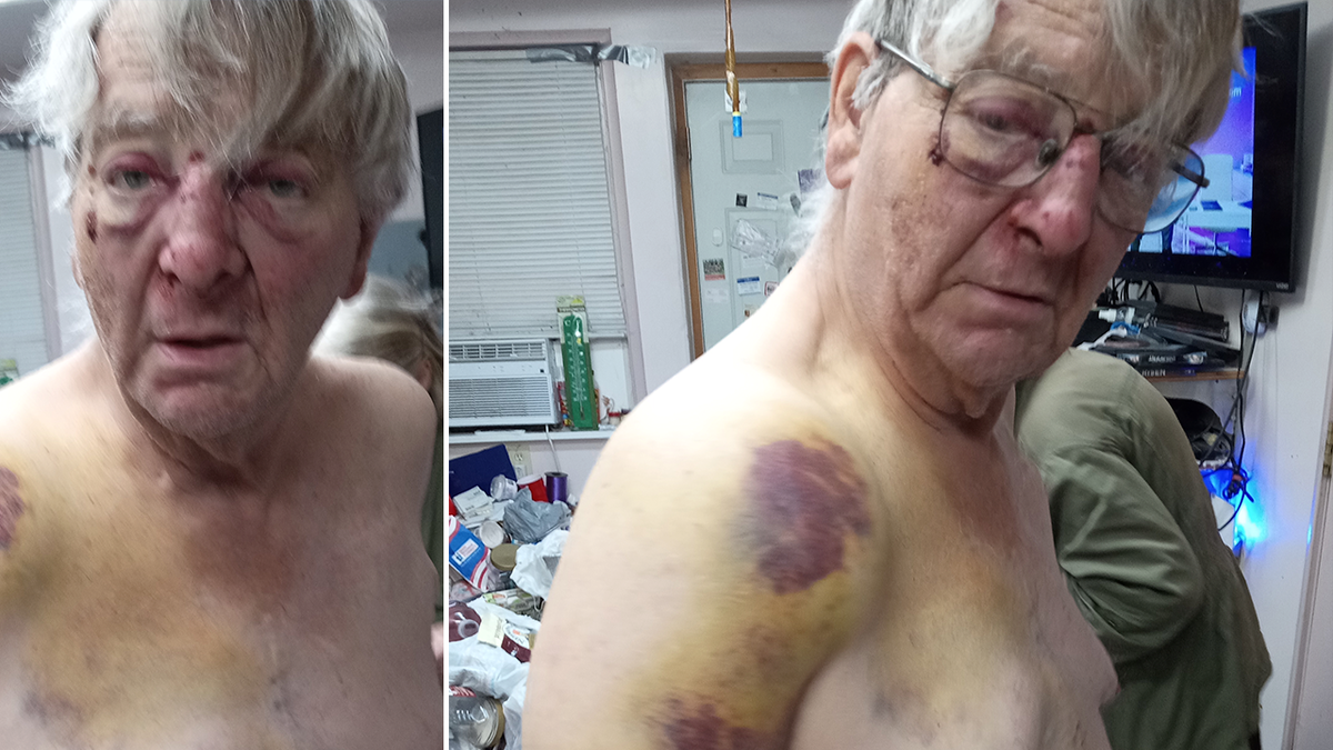 Elderly man injuries