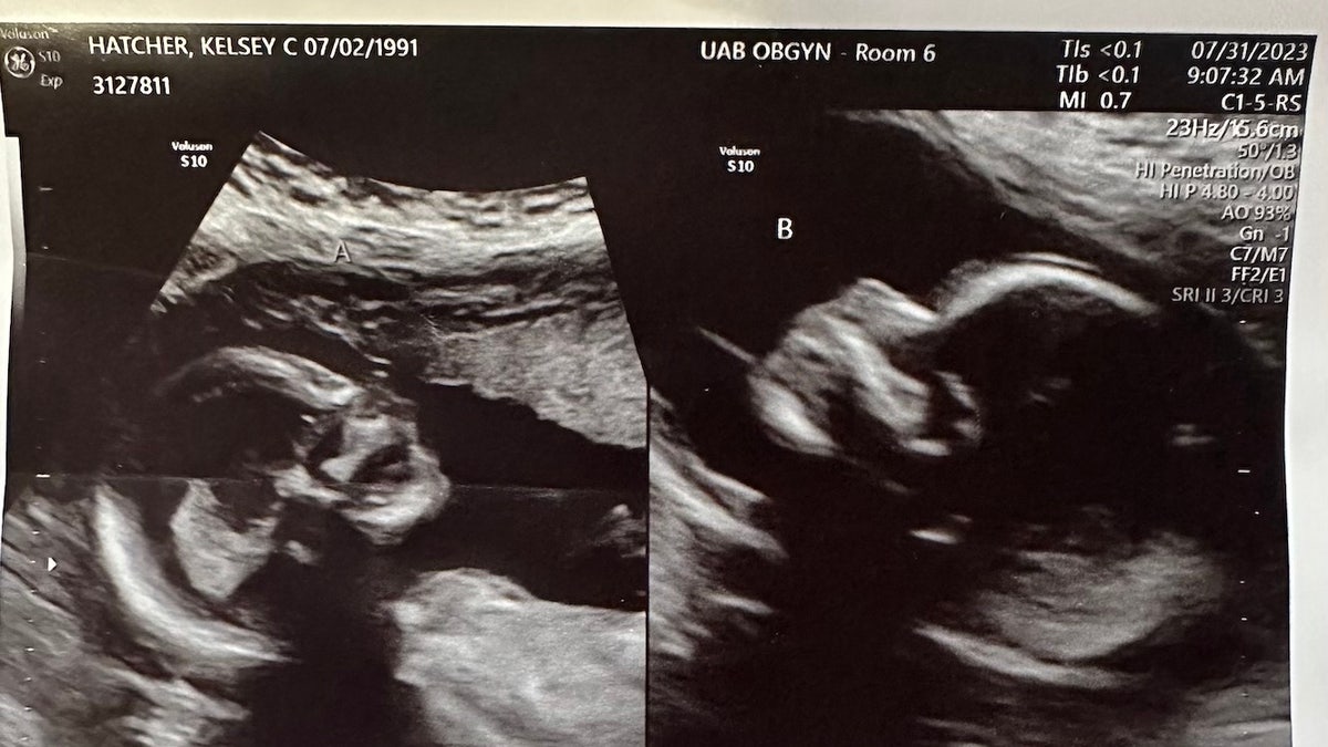 Twin pregnancies ultrasound