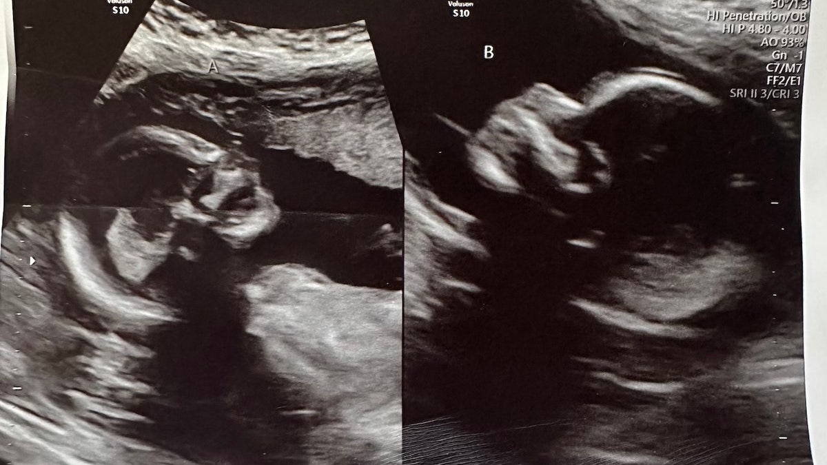 Twin pregnancies ultrasound