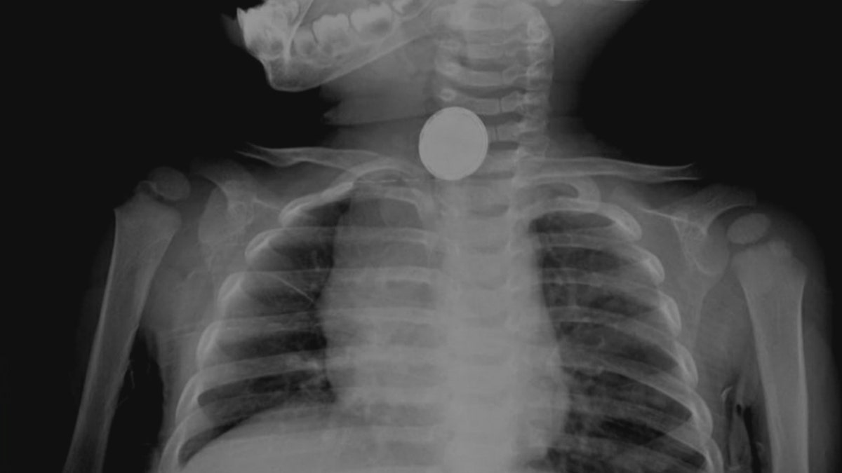 X-ray coin swallowed