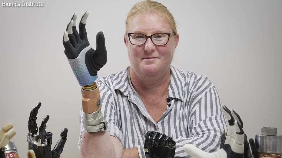 Meet the first person ever to receive a fully functional bionic hand with AI