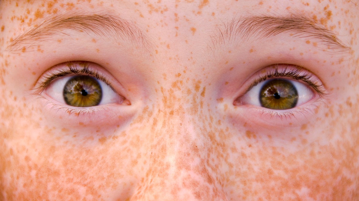 freckles on child's face