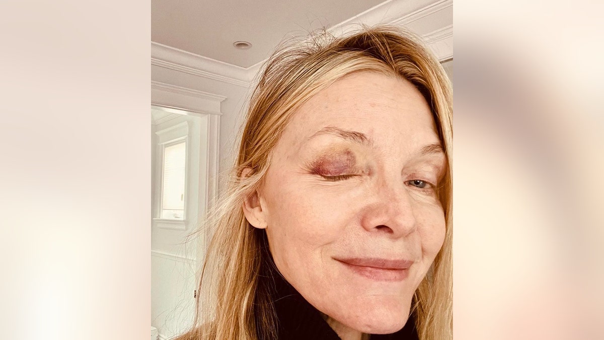 Michelle Pfeiffer mostra uma de suas pálpebras machucadas em uma selfie