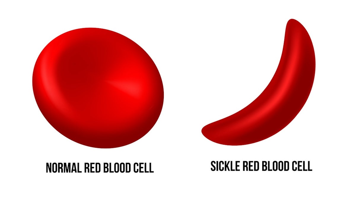 Sickle cell example