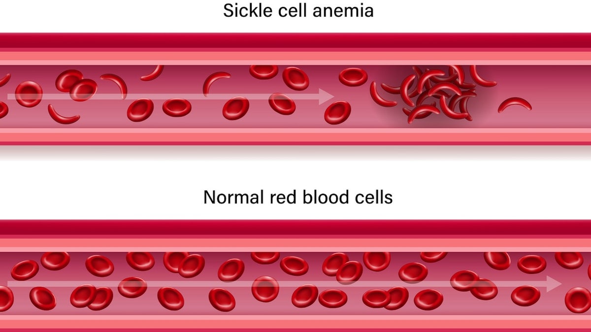 Sickle cell comparison