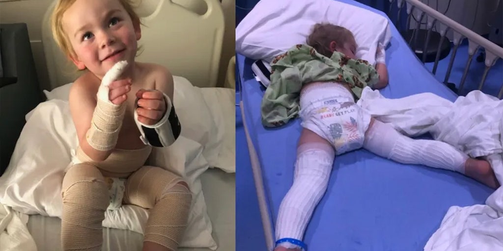 Florida boy recovering from freak accident that left him badly burned: 'His pants were melting' - Vimarsana News