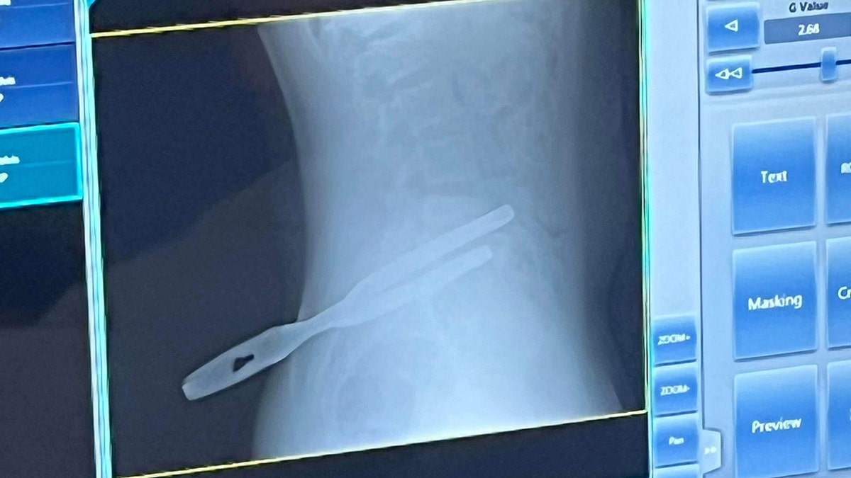 Xray showing the pliers