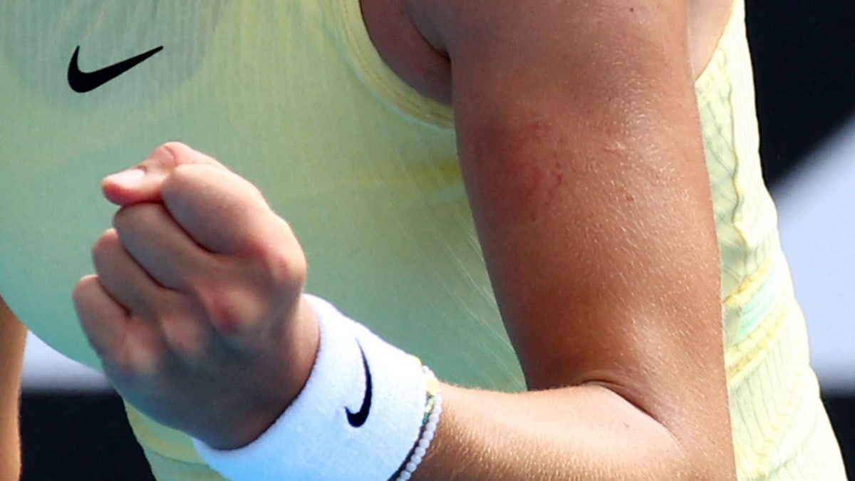 Mira Andreeva's bite mark
