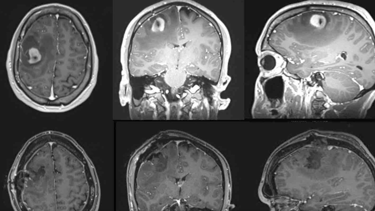 Christian Nolen's brain scans