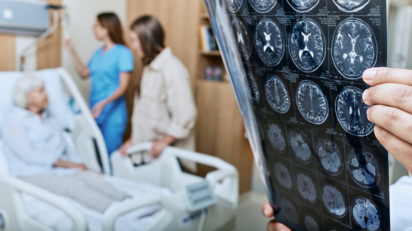 alzheimers patient brain scans
