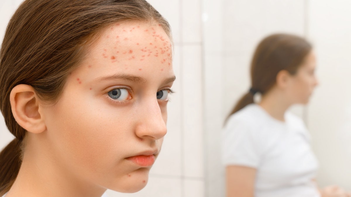 Girl with measles