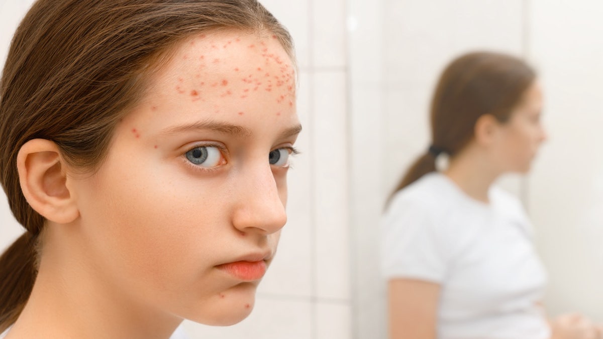 Girl with acne