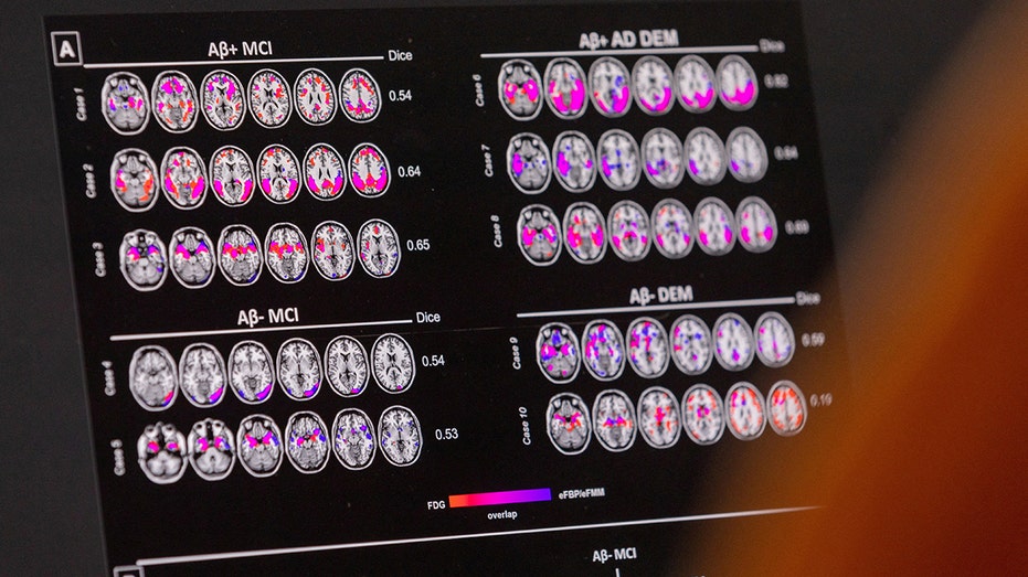 Study finds that proteins may predict who will get dementia in 10 years based on blood samples