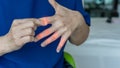Overuse hand problems. Woman&rsquo;s hand with red spot o fingers as suffer from Carpal tunnel syndrome. The symptoms of tingling, numbness, weakness, or pain of the fingers and wrist.