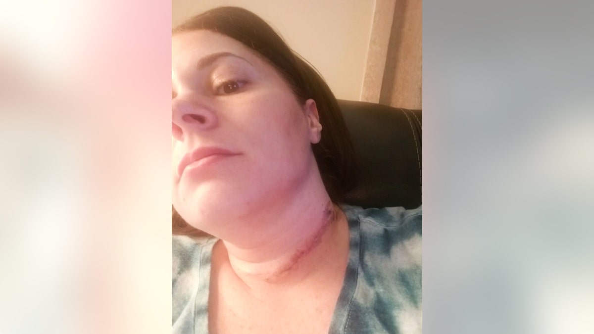 Jennifer Walter pictured with a scar on her neck