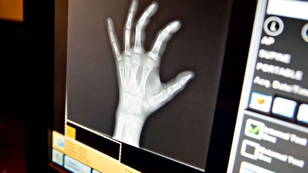 Hand X-ray displayed on screen
