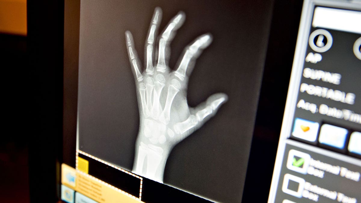 Hand X-ray displayed on screen