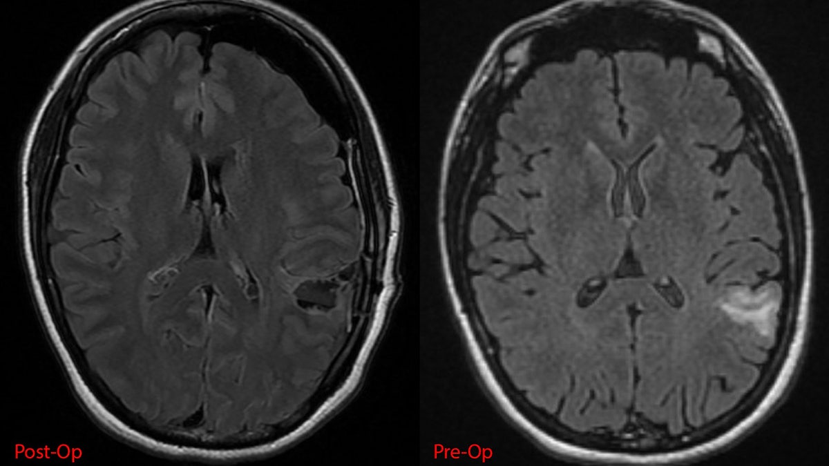 campione's brain screening