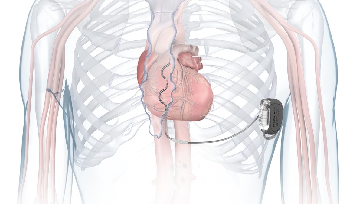 MDT Aurora EV-ICD illustration in chest_low res 1