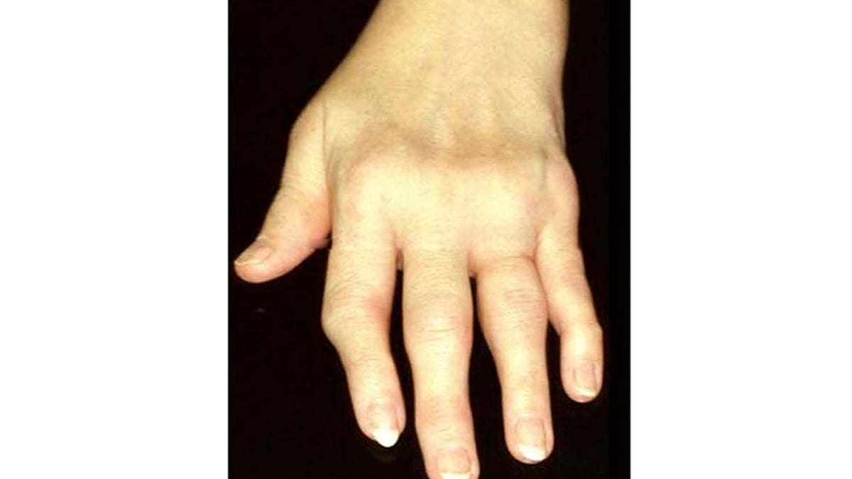 Hand with rheumatoid arthritis