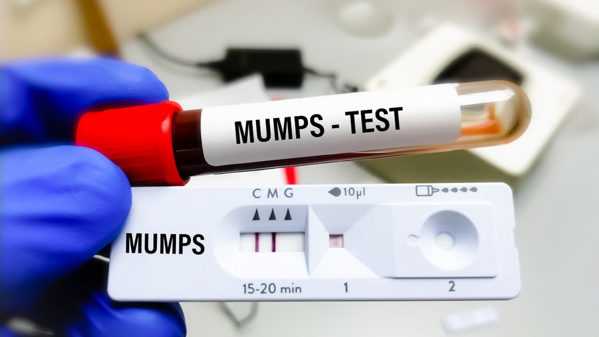 Mumps test