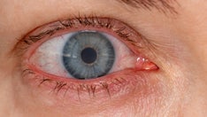 Ask a doctor: ‘Why are my eyes often bloodshot?’