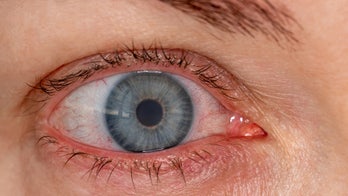 Ask a doc: ‘Why are my eyes often bloodshot?’