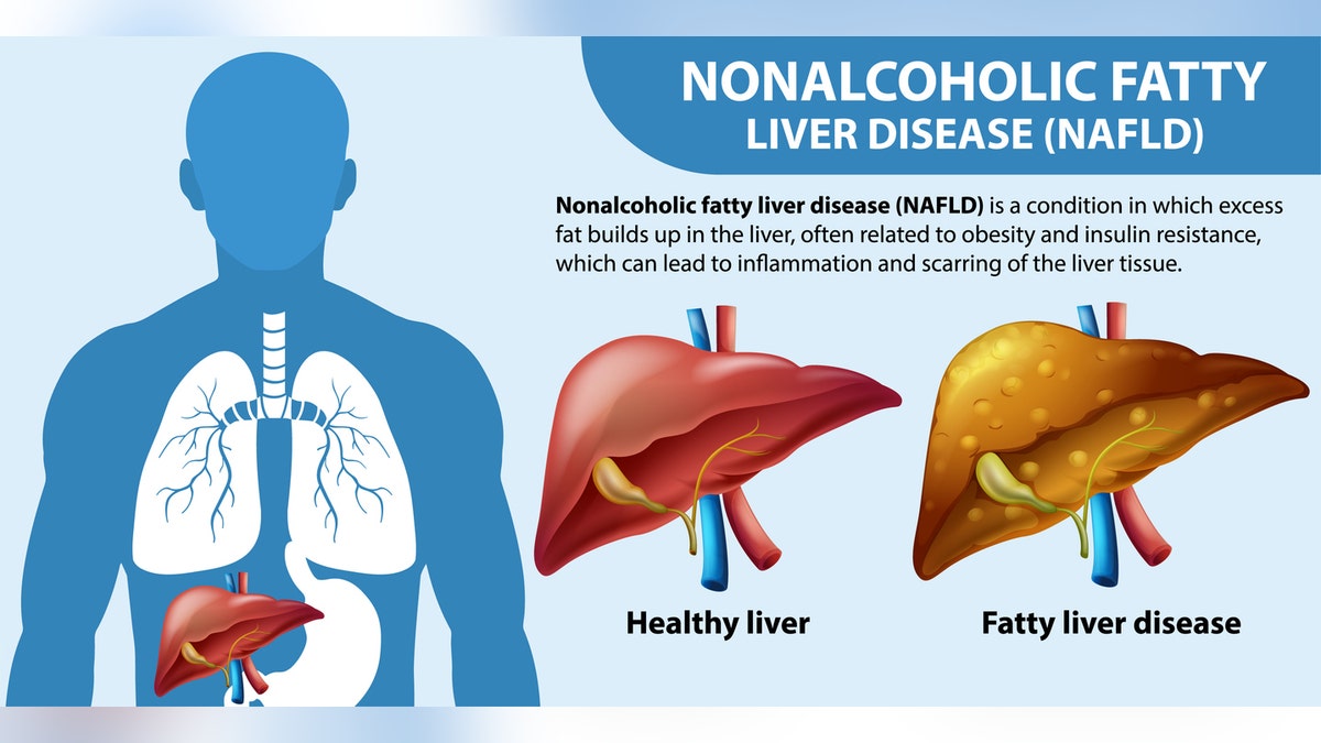 NAFLD