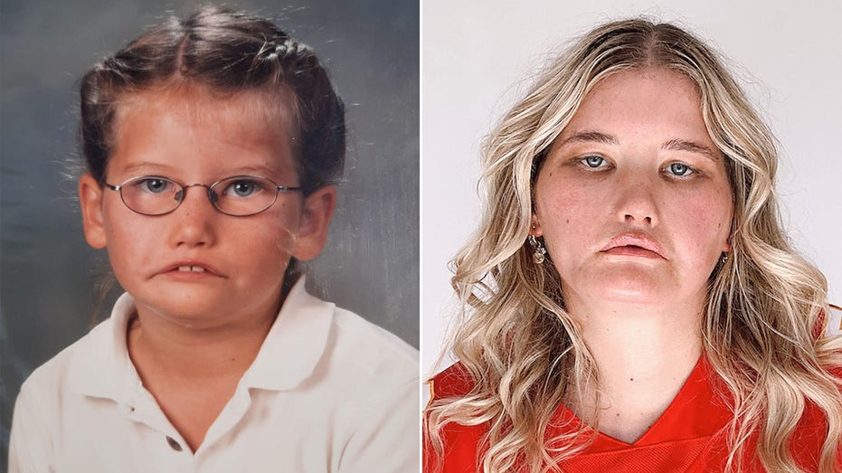 The girl who can’t smile: How a rare disorder became a young woman’s ‘greatest gift’