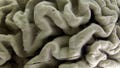 A section of a human brain with Alzheimer's disease is displayed at the Museum of Neuroanatomy at the University at Buffalo, in Buffalo, N.Y., Oct. 7, 2003. A long-feared gene appears to do more than raise people&rsquo;s risk of Alzheimer&rsquo;s: Inheriting two copies can cause the mind-robbing disease, according to research published in the journal Nature Medicine on Monday, May 6, 2024.