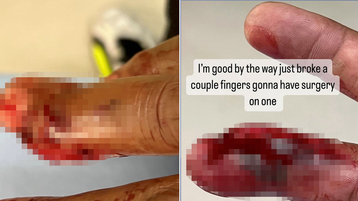 Paul Pierce's finger injury