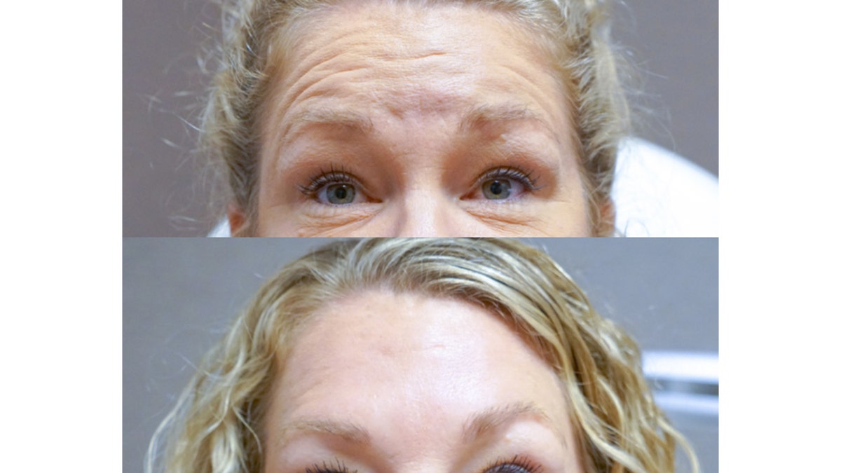 Neurotoxin injectable before and after