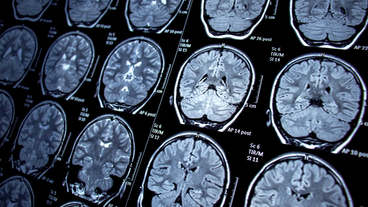 Alzheimer’s breakthrough: researchers confirm ‘protective gene’ delays disease 1 Brain scans