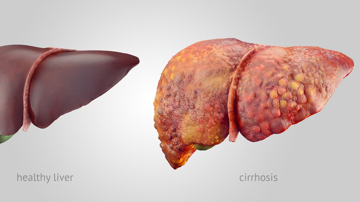 Healthy and diseased liver