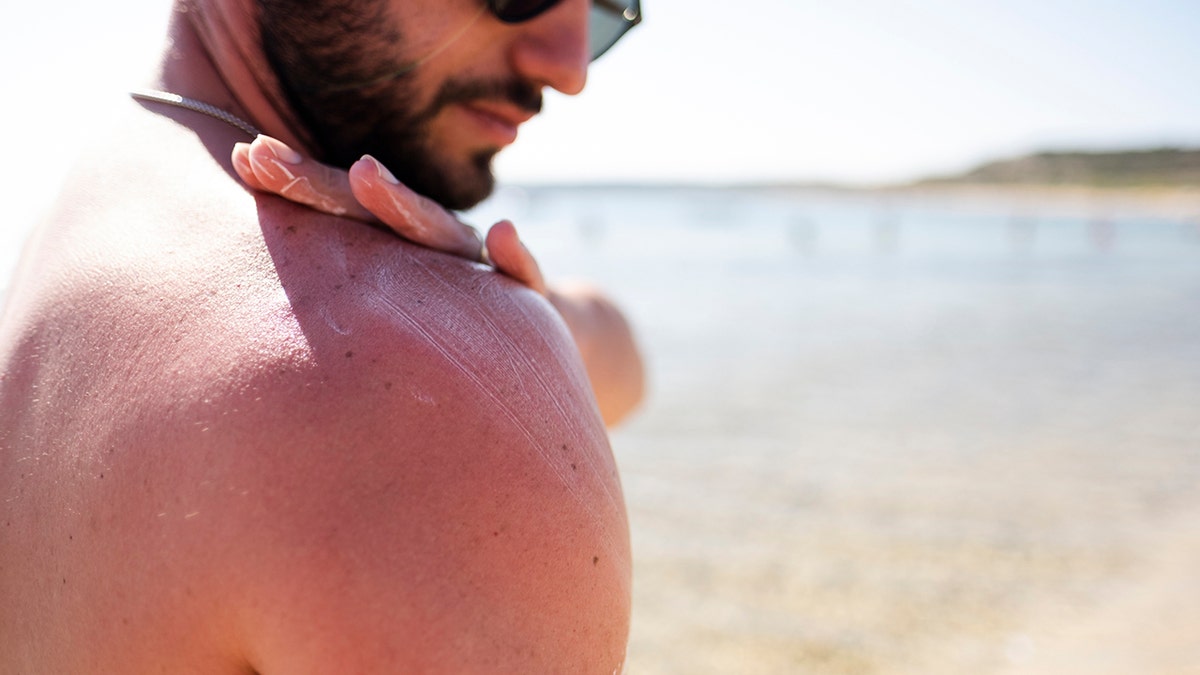 man applies sunscreen to his shoulder on the beach