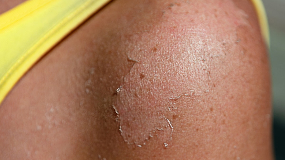 Peeling of the skin on the shoulder after sunburn