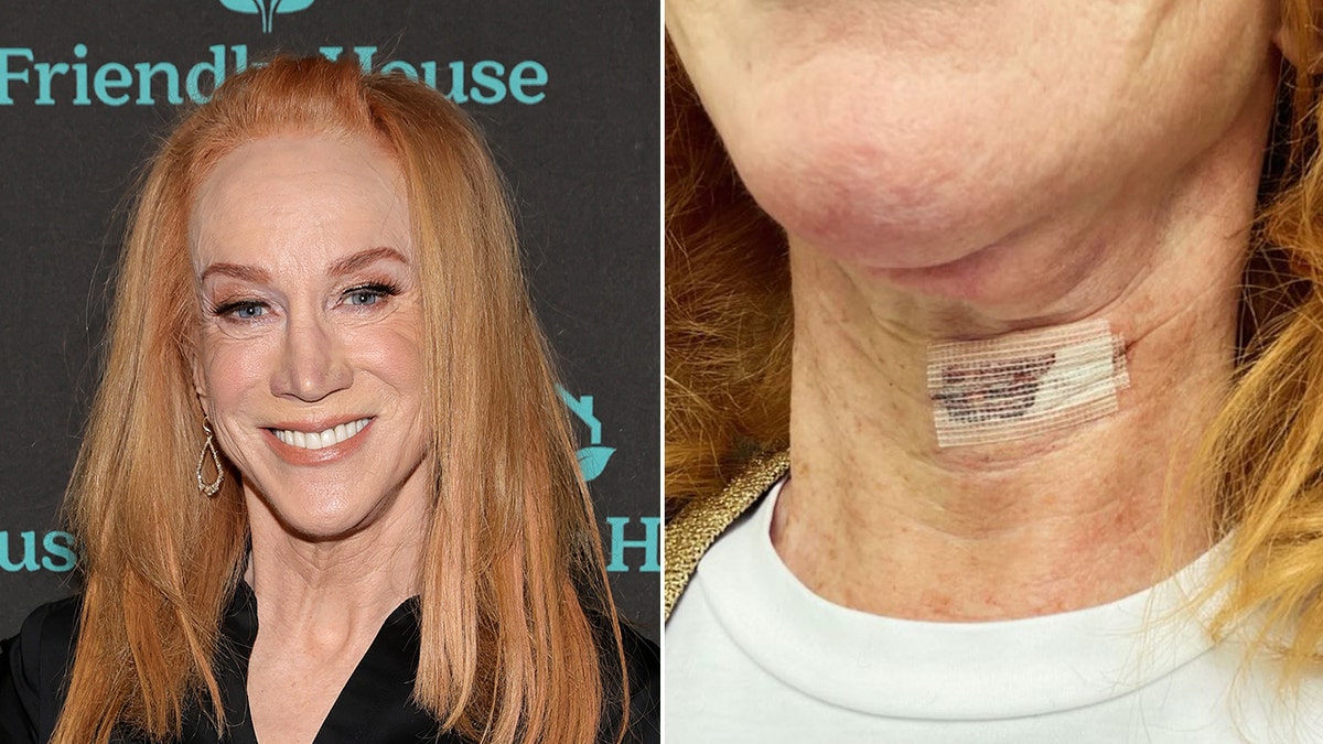 kathy griffin split with kathy griffin surgery scar