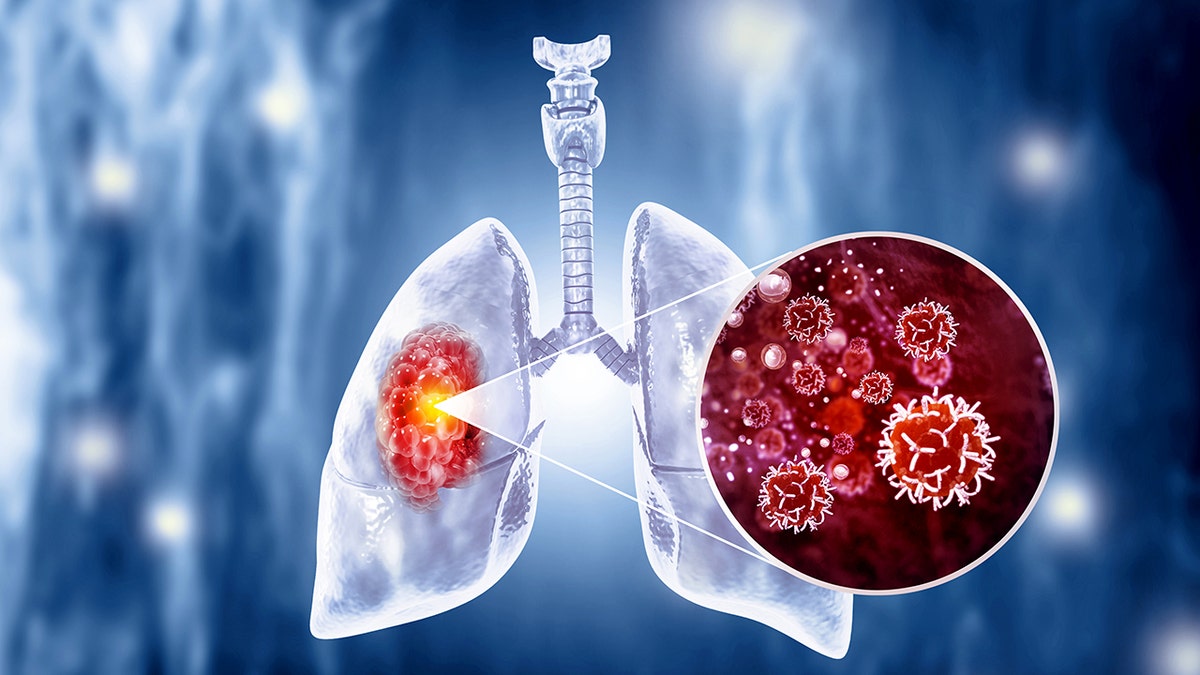 Foto conceitual mostrando câncer de pulmão