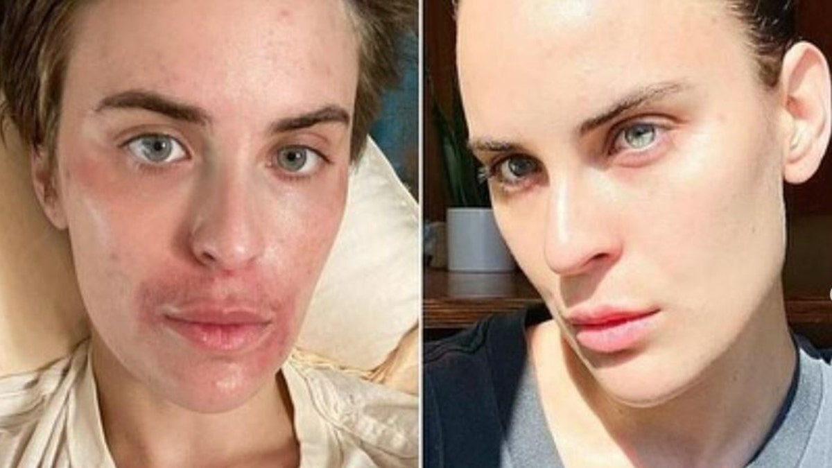 Tallulah Willis shows recovery efforts while on journey with skin-picking disorder.