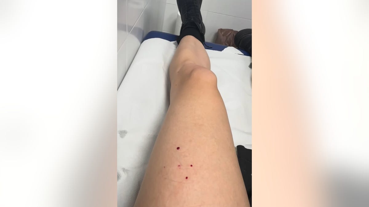 bat bite on taylor momsens leg