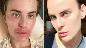 Bruce Willis' daughter shares photos of journey with skin-picking disorder, celebrates 'small wins'
