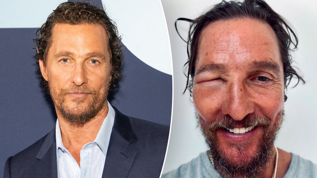 Matthew McConaughey on the red carpet and with a swollen eye split