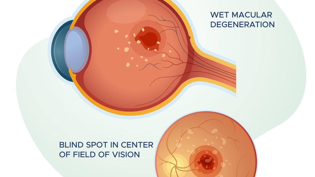Florida woman says playing pickleball saved her sight: ‘I was really worried’ 3 Wet macular degeneration