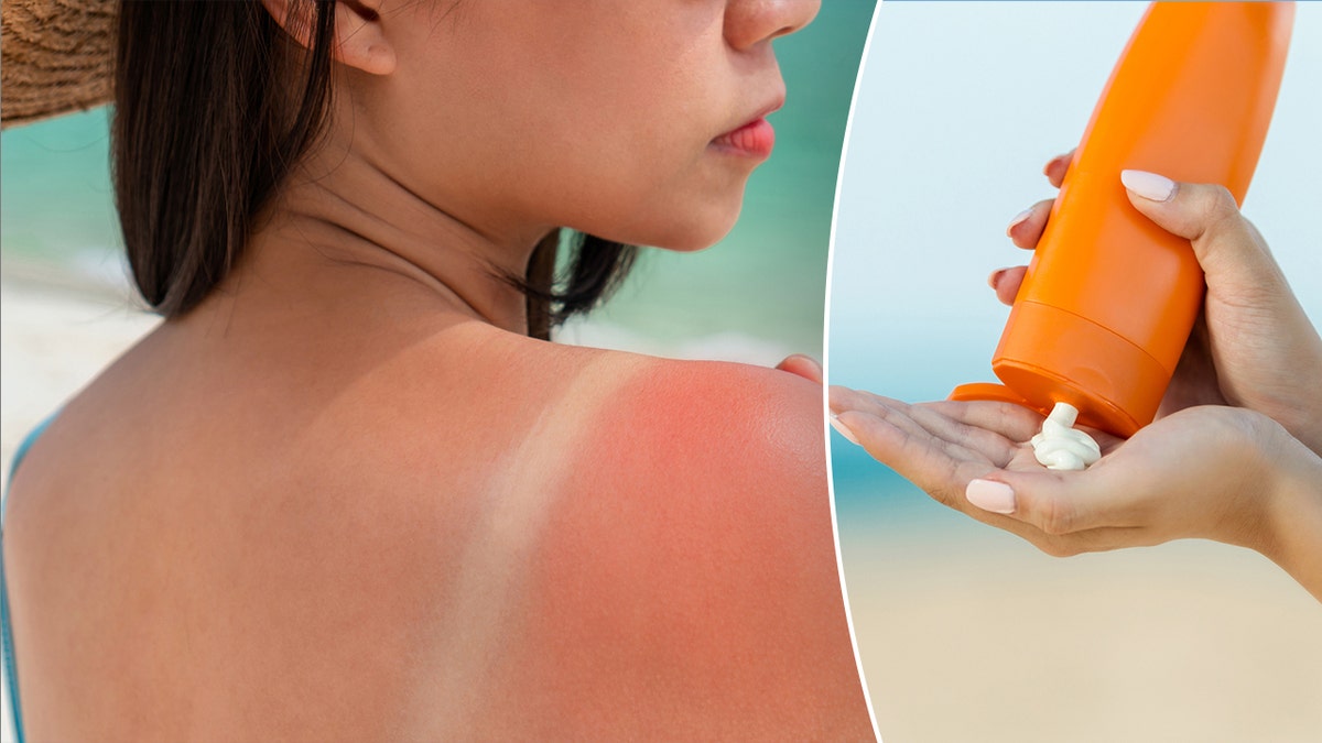 Woman with sunburn next to sunscreen bottle