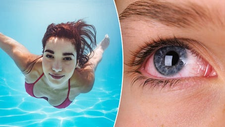 Ask a doctor: ‘Is it safe to swim underwater with my eyes open?’ Here's what experts say
