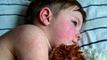 Viral disease. Measles rash on the body of the child. Allergy. - Fox News
