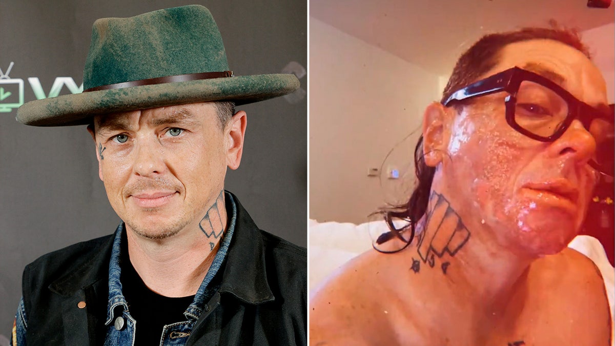 Side-by-side photos of Sid Wilson on the red carpet and his face burn on Instagram