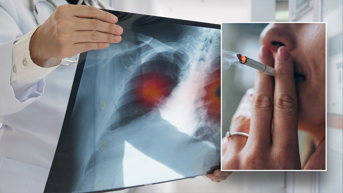 Doctor holding lung x-ray and woman smoking