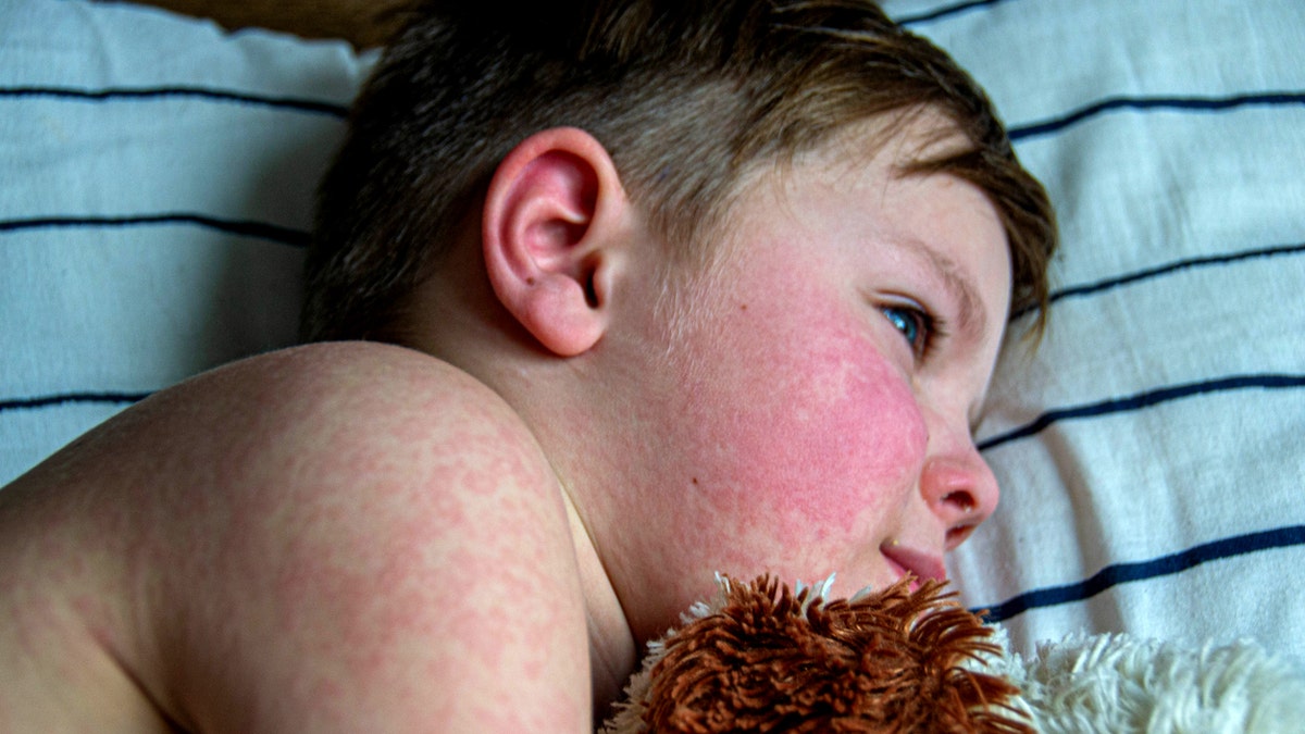 Texas confirms growing measles outbreak affecting school-aged children